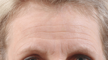 Why the Forehead Is the Most Problematic Area to Treat With Anti-Wrinkle Injections